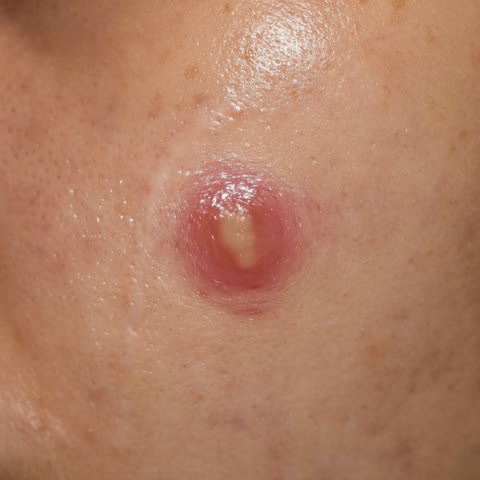 สิวหัวช้างเป็นไต: สิวที่มีลักษณะเป็นก้อนนูน แดงขนาดใหญ่ ภายในเป็น โพรงมีหนองปนเลือดที่เกิด จากการอักเสบรุนแรงใต้ชั้น ผิวหนัง