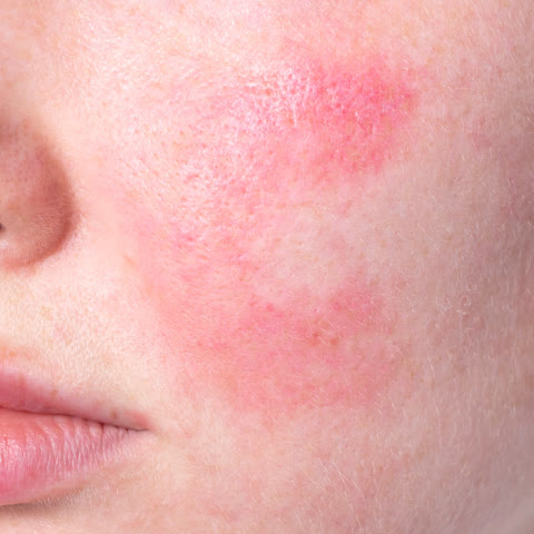 หน้าแดงอักเสบ