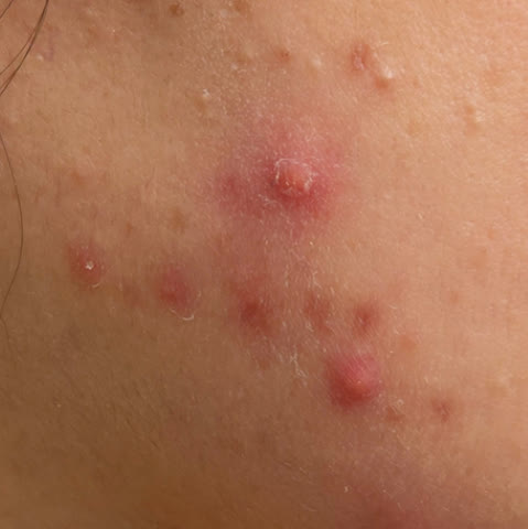 สิวอักเสบ: สิวที่มีลักษณะเป็นตุ่มนูนแดงเข้ม เป็นสิวที่กดแล้วเจ็บ