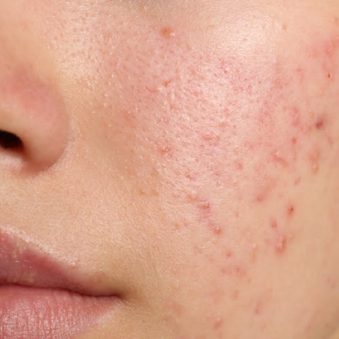 เล็กน้อย: ส่วนมากเป็นสิวอุดตัน อยู่เฉพาะที่ใบหน้า